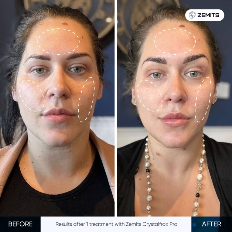 Zemits CrystalFrax PRO نظام الترددات الراديوية الجزئية غير الجراحية