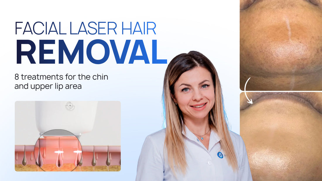 A Comfortable Laser Hair Removal Course for Dry, Pigmentation-Prone Skin: 10 Sessions for Fitzpatrick Skin Type II