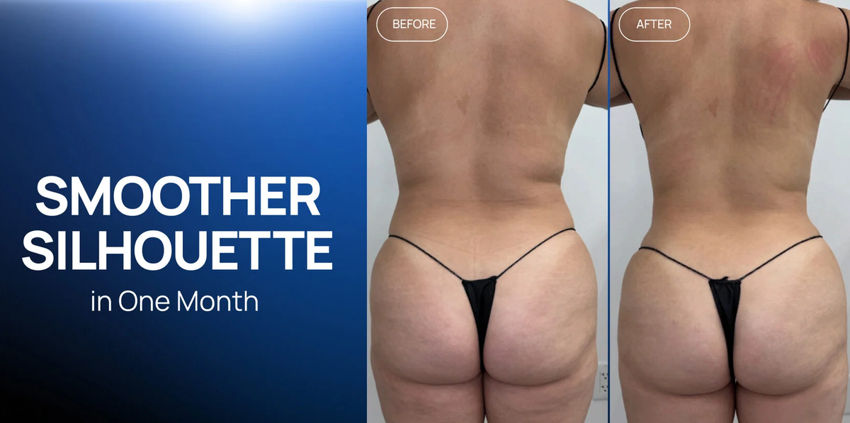 A Multi-Step Body-Contouring Protocol: A Smoother Silhouette in One Month