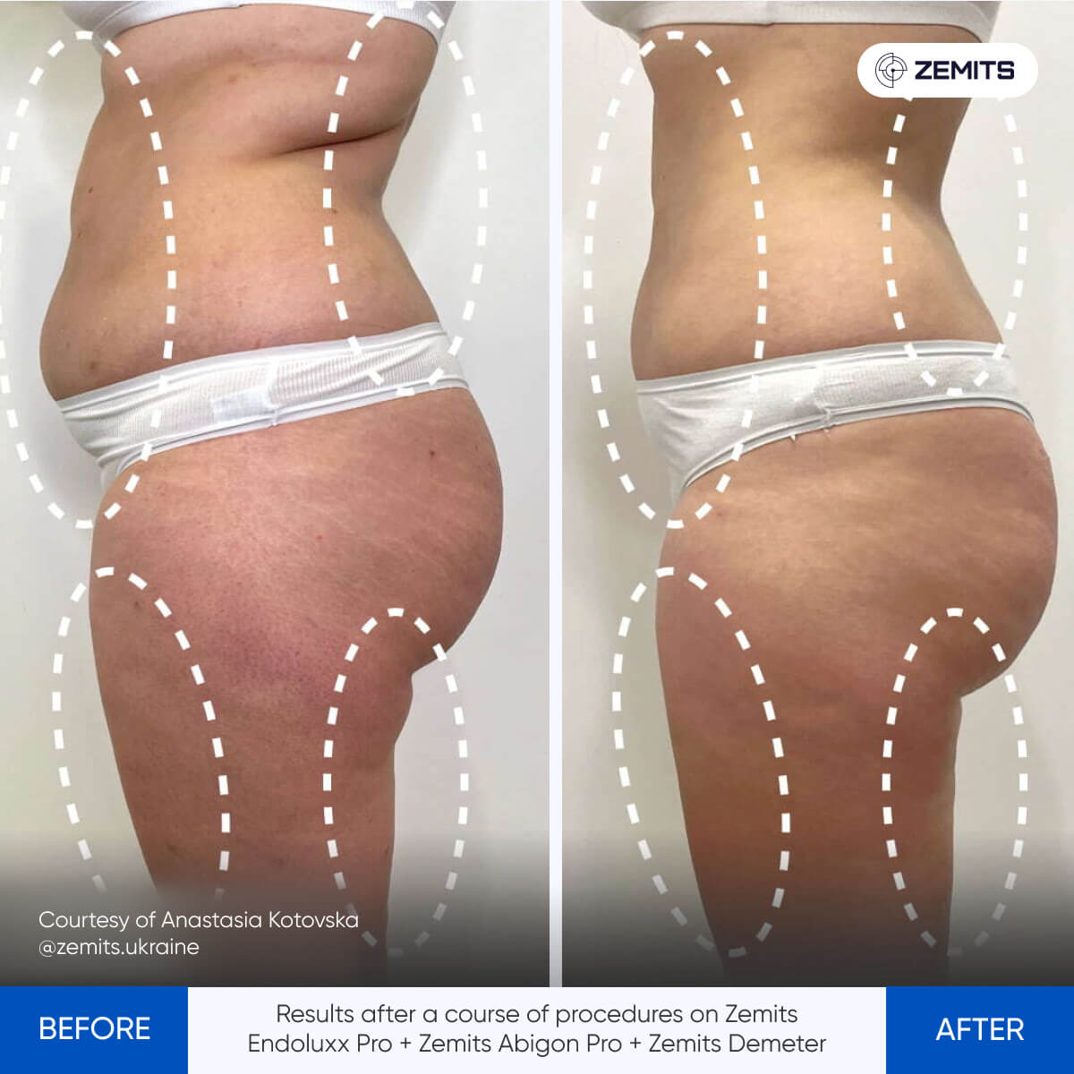 Before and after body sculpting results Zemits Abigon Pro